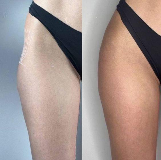 Hyaluronic Acid for the Face