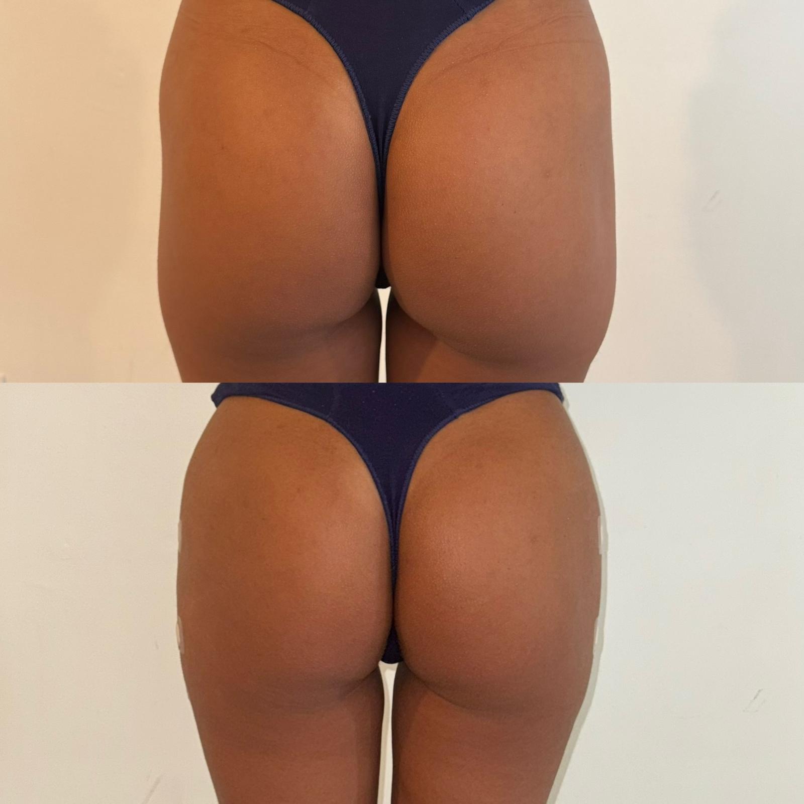 Skin Hydration with Hyaluronic Acid