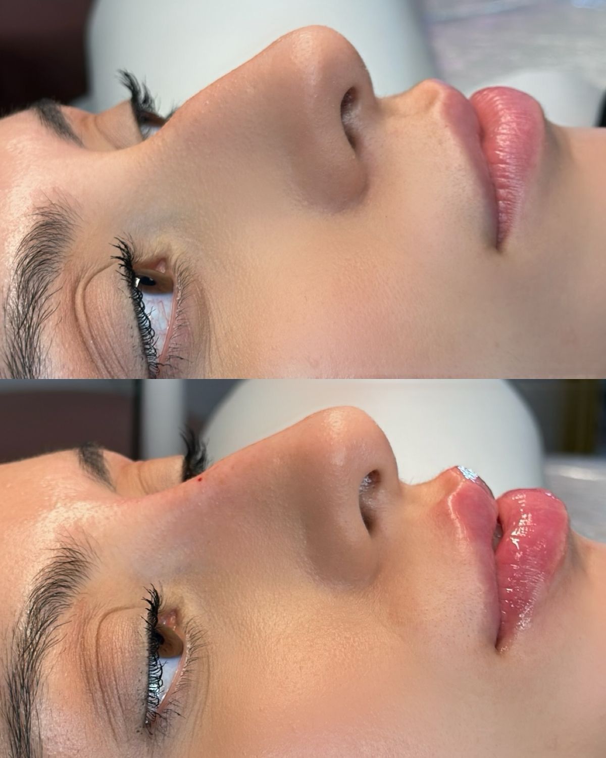 Hyaluronic Acid for the Face