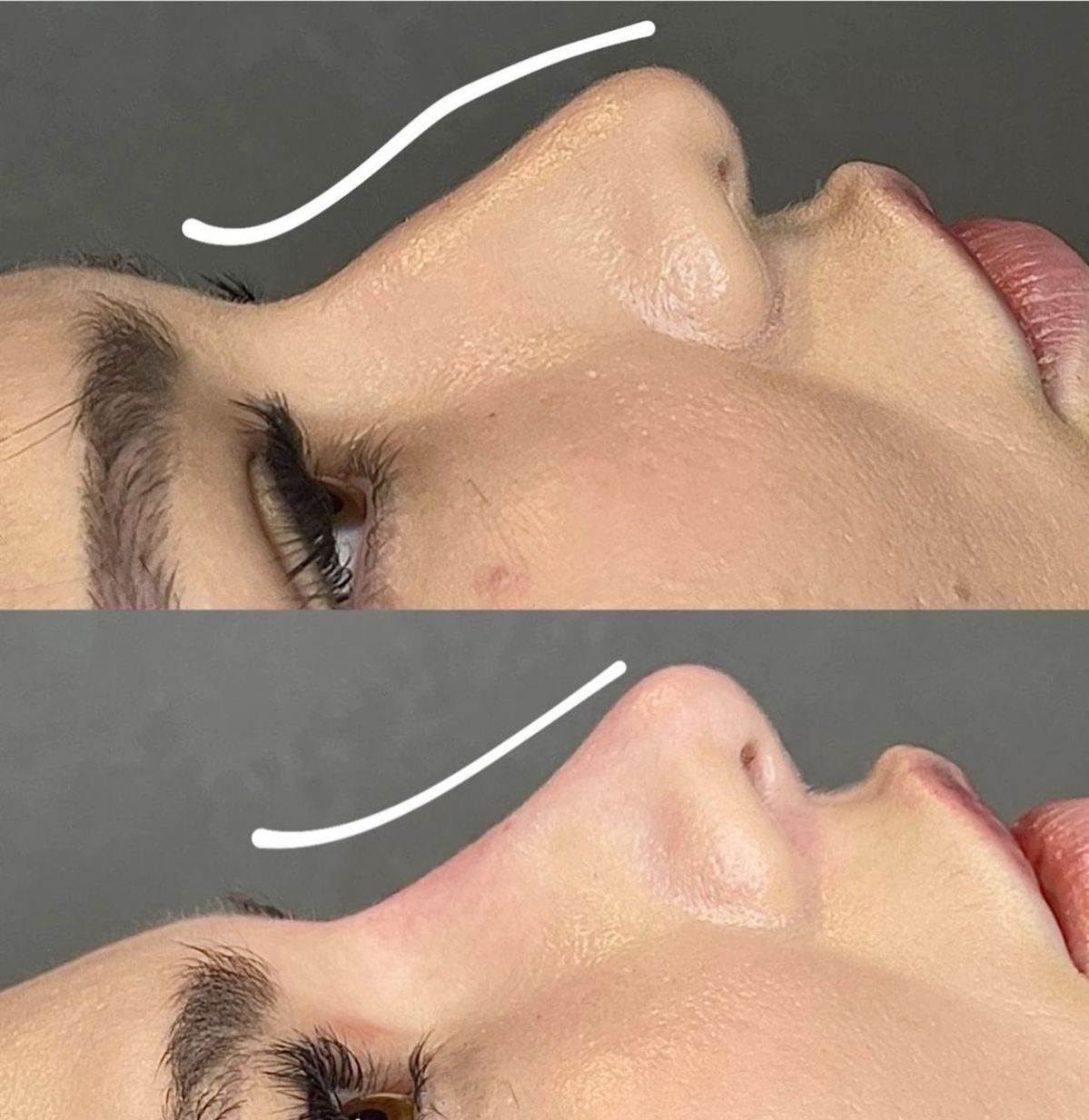 Hyaluronic Injection Process