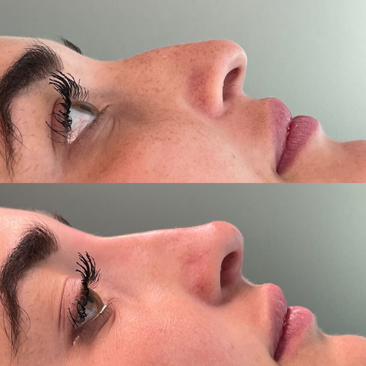 Hyaluronic Injection Areas