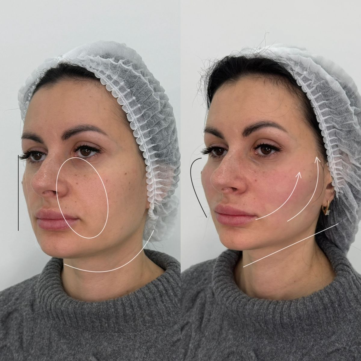 Facial Areas for Hyaluronic Treatment