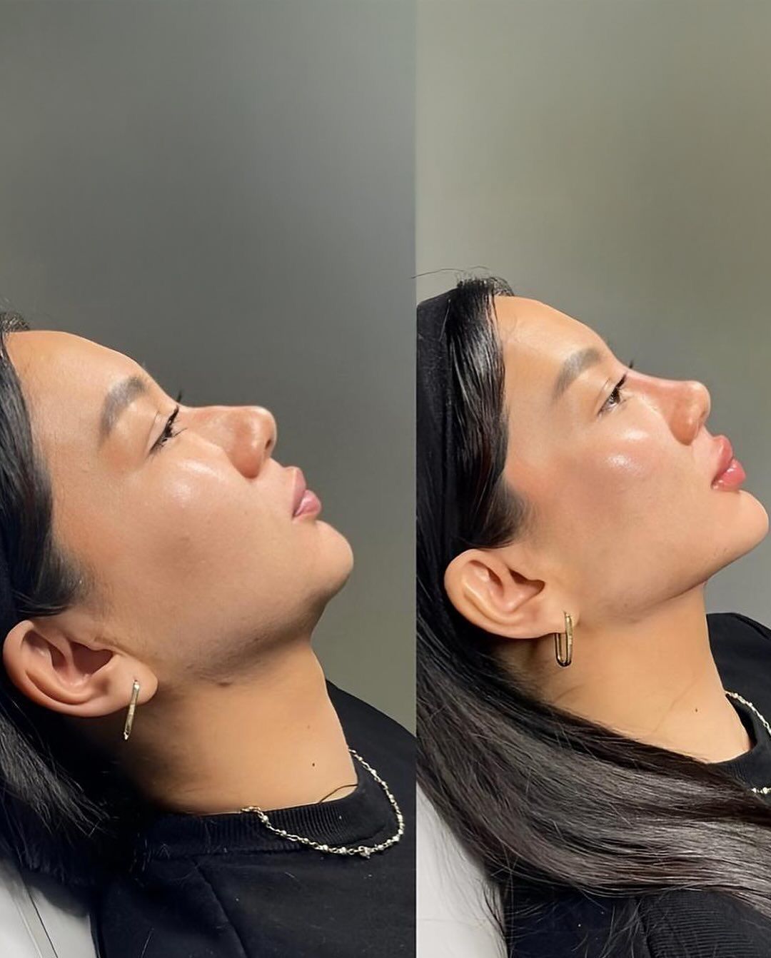 Skin Hydration with Hyaluronic Acid