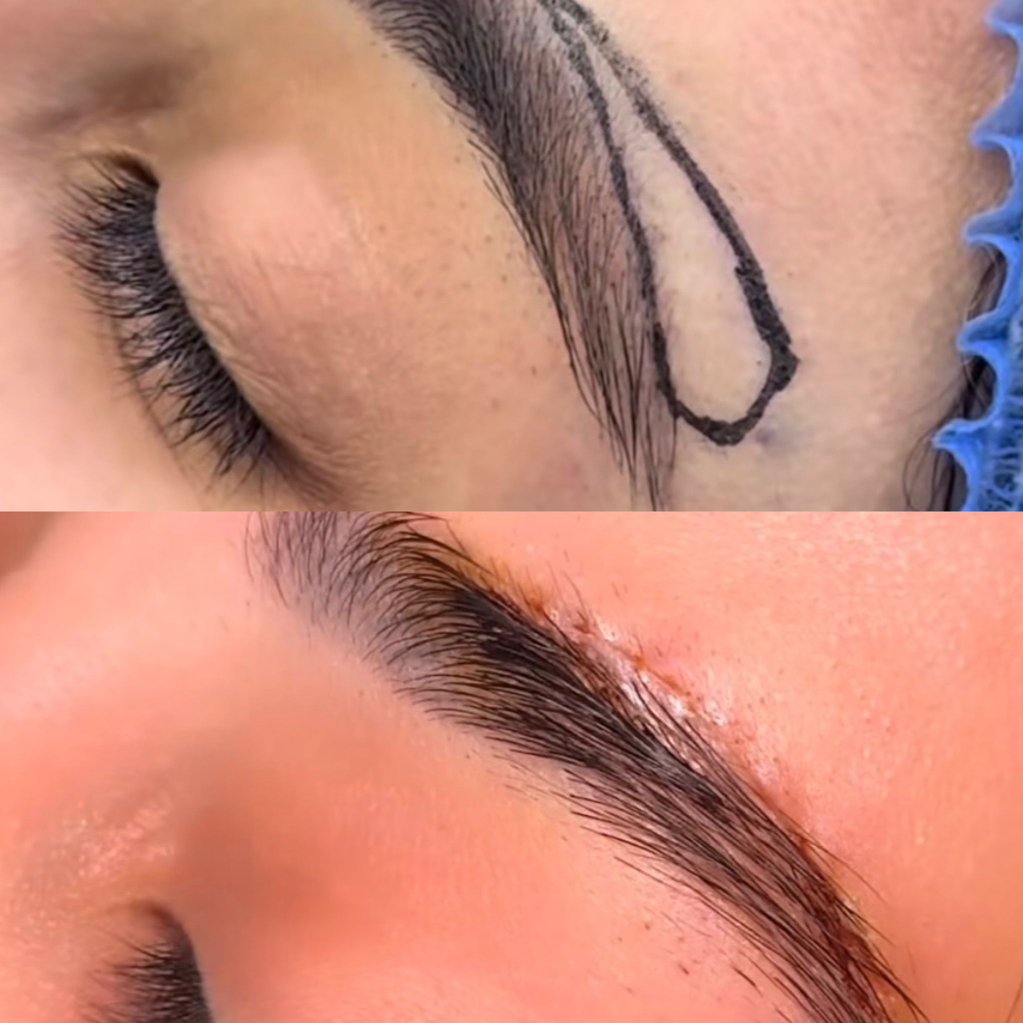 Surgical Brow Lift