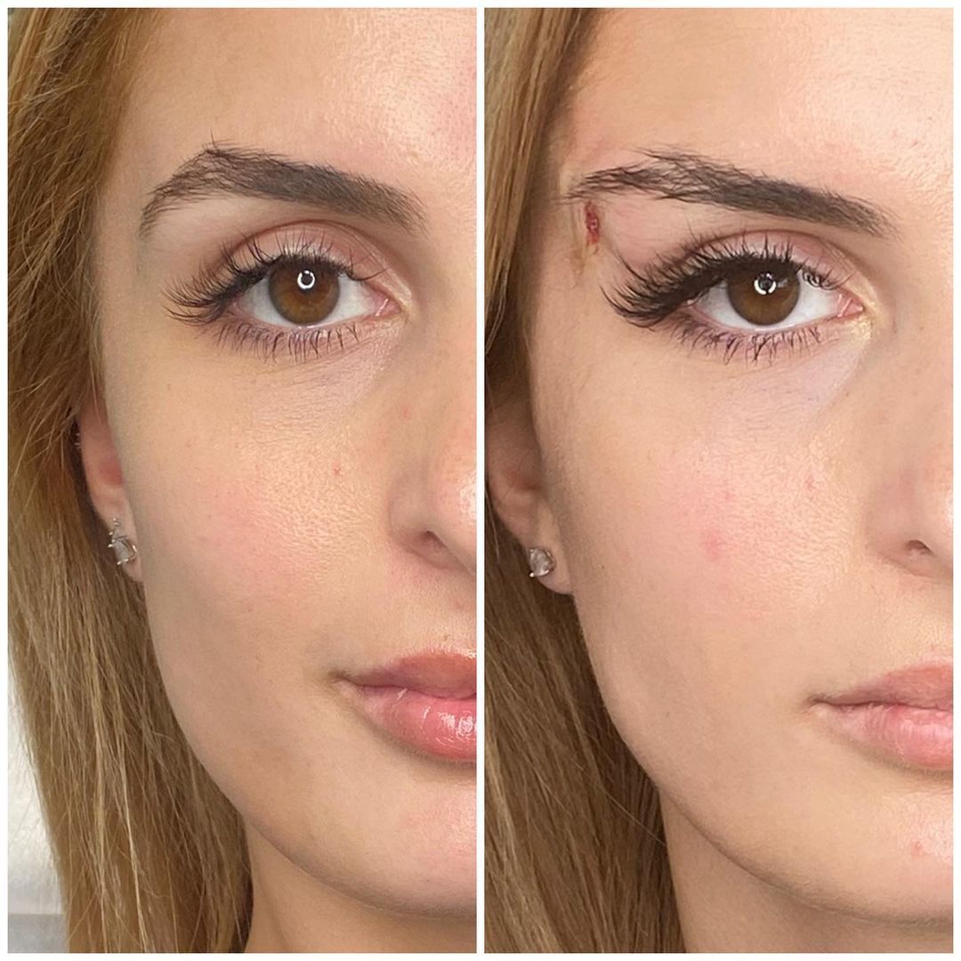 Thread Lifting (Suspension Threads)